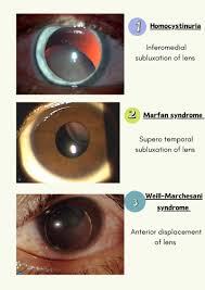 Image result for Homocystinuria