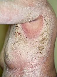 Image result for scabies norvegica