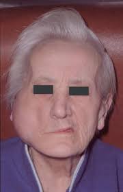 Image result for Sialoadenitis