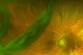 It is imperative that a retinal tear be diagnosed early. Flashes Floaters