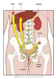 Depending on the type and stage of the cancer, treatments may be the best time for treating testicular cancer is when it is diagnosed in its initial stages. Testicular Cancer Patient Information