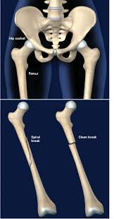 Image result for Fractures in Children