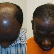 This article is for those who are seeing very advanced signs of balding where the middle of your head reflects the light and you don't know what to do with all the hair that's still there on the sides. Regrow Your Bald Head Using This Natural Hair Regrowth Remedy Home Facebook