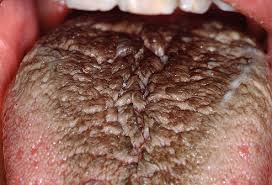 Image result for brown tongue symptoms