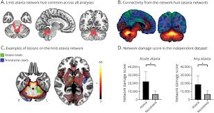 Image result for Neurologic Lesion Localization
