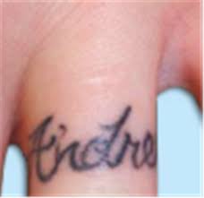 Home tattoo removal methods that don't work. Tattoo Removal Before And After Photos By Mariam Awada Md Facs Southfield Mi Case 40291 Asps