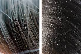 Image result for lice vs dandruff