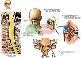 Cervical Spine Surgery Spine Surgery C4 C5 And C5 C6 Cervical Laminectomy And Foraminotomy Spine Surgery Cervical Spinal Stenosis Cervical