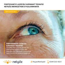 Femtosaniye Lazer Ile Katarakt Tedavisi Genellikle Ileri Yaslarda Gorulen Ve Ciddi Gorme Kaybina Neden Olan Katarak Hastaliginin Ileri Teknolojil Gozler Gozluk