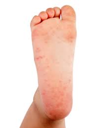 Dyshidrotic eczema is a form of eczema (inflammation of the skin) which can affect anyone, but it more commonly affects adults aged below 40 years. It S Not Strep Throat Treating Hand Foot And Mouth Disease University Of Utah Health