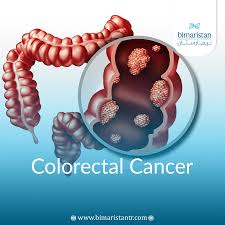Image result for Colorectal Cancer