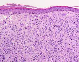 2012 update of the consensus statement from the international mesothelioma interest group husain an. Spitz Tumors Of The Skin Sciencedirect