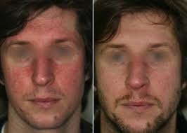 La rosacée (couperose) est une maladie de peau qui touche les petits vaisseaux sanguins. Rosacee Couperose Acne Rosacee Et Traitement Dr Abimelec