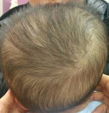 Image result for Positional Head Deformity