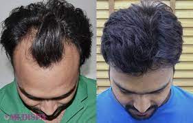 Hair Transplant For Progressive Hair Loss Hairloss Hairfall Haircare Hairtransplant Hairtransplantcost Hair Transplant Hair Loss Remedies Rapid Hair Loss