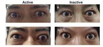 Thyroid Eye Disease How A Novel Therapy May Change The Treatment Para Tcrm