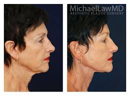 Surgical Treatment Of Facial Aging Changes Must Therefore Be Carefully Individualized To Match Each P Facial Rejuvenation Facial Plastic Surgery Facial Plastic