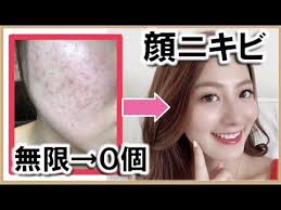 ニキビを本気で治す方法 8年間皮膚科に行っても治らなかった全顔ニキビを治した方法 肌荒れ youtube ニキビ 肌荒れ 皮膚科