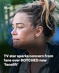 She's ignited plastic surgery speculation 😢 Read more:  https://trib.al/YaA9hG0