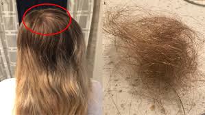 Handfuls of hair can come out when you shower or brush your hair. Cureus Bariatric Surgery Induced Telogen Effluvium Bar Site Case Report And A Review Of Hair Loss Following Weight Loss Surgery