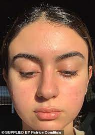The opposite is true of people with. Student Who Developed Cystic Acne After Laser Hair Removal Reveals How She Healed Her Scars Daily Mail Online