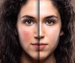 Everything You Need To Know about Rosacea