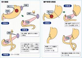 「胃がん手術」の画像検索結果