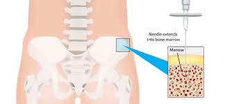 Image result for Bone Marrow Exam