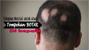 Jika masalah rambut gugur disebabkan oleh stres, jangan bimbang kerana ia hanya sementara dan rambut akan tumbuh semula. Botak Bertompok Boleh Sembuh Dengan Cara Ini Ohcantik Com