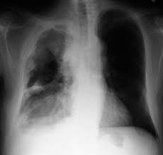 Mesothelioma Pulmonary Disorders Msd Manual Professional Edition