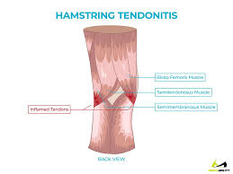 Pain Behind Knee Why It Hurts In Back Of Or Under Your Kneecap