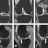 Mr arthrogram knee loose osteochondral lesion. Https Encrypted Tbn0 Gstatic Com Images Q Tbn And9gcsh54uwzg7qkrkp37iuc4kww8cu5t8lk1hagm1dei0jdp629xrn Usqp Cau