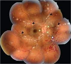 Candle Wax Dripping Lesions In Sarcoidosis Jama Ophthalmol 2017 135 8 E171845 Doi 10 1001 Jamaophthalmol Candle Wax Dripping Optometry Fundus Photography