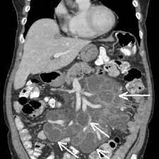 Pdf Cavitating Mesenteric Lymph Node Syndrome And Enteropathy Associated T Cell Lymphoma As First Manifestation Of Celiac Disease