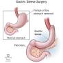 bariatric surgery from my.clevelandclinic.org