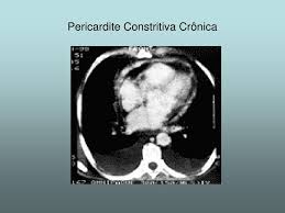A pericardite constritiva é uma inflamação crônica ou de longo prazo do pericárdio. Ppt Doencas Do Pericardio Powerpoint Presentation Free Download Id 963460
