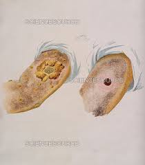 Image result for Smallpox