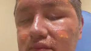 Fundraiser for Maria Barbara Pacheco by Mario Reyes : Help Mario's skin  burn medical bills