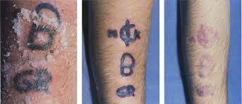 These 4 are the best surgical methods to remove permanent tattoos hydrogen peroxide is another common household item that is used to remove permanent tattoos. Low Cost Salabrasion Technique For Home Tattoo Removal At Home Tattoo Removal Tattoos Tattoo Removal
