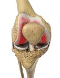 Hvad er androgen insensitivitetssyndrom (ais)? Gonarthrose Gelenk Klinik De