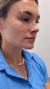 Restoring Radiance with RHA💉, In 2022, I had the pleasure of treating my  wonderful client with RHA 2 and 3 to address radial cheek lines. Now, two  years later (2024) she returned and the results have ...