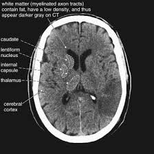Image result for CT Head