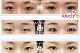 Eyelid Surgery In Korea Seoul Touchup