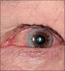 It can occur at if glaucoma is recognized early, vision loss can be slowed or prevented. Glaucoma The Lancet