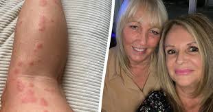 British holidaymaker scarred from 200 bedbug bites