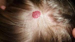 Penyebab bisul di kepala bayi dan cara mengatasinya. Dok Adik Saya Yang Bayi Ada Bisul Di Kepalanya Kenapa Ya Tribun Kaltim