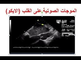 تقرير اشعة ايكو عند قراءة مصطلحات ايكو القلب يجب الانتباه إلى Lvef والذي