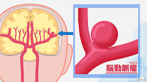 本站内容可能令人反感；不将本站内容派发，出售。 出租，交给或出借予年龄未满18岁人士出示，播放或播映。 this article contains material which may offernd and may not be distributed,circulated,sold,hired,given,lent,shown, played or projected to a. ãã‚‚è†œä¸‹å‡ºè¡€ã®åŽŸå›  æœªç ´è£‚è„³å‹•è„ˆç˜¤ ã®ç—‡çŠ¶ã¨æ²»ç™‚æ³• Nhkå¥åº·ãƒãƒ£ãƒ³ãƒãƒ«