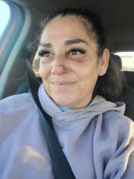 It's now been a little over 2 months since I fell and broke both ankles and  legs. I've been trying really hard to stop smoking so I heal better but  it's really