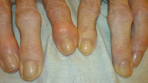 Do I Have Arthritis Early Symptoms